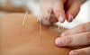 MS Acupuncture Clinic Coupons Camarillo, California Deals