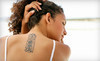 Dallas Tattoo Removal Clinic Coupons Dallas, Texas Deals