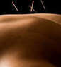 Lakewood Ranch Acupuncture & Wellness Coupons Bradenton, FL Deals